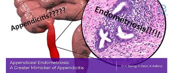 The color is attributed to hemolyzed blood from ectopic endometrium that is encapsulated by adhesions or fibrotic tissue. Appendiceal Endometriosis Endonews