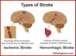 Hasil gambar untuk stroke