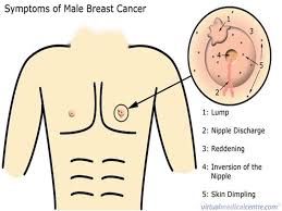 The most common symptom is a hard but painless lump in one of the breasts. Breast Cancer In Men Signs And Symptoms Ppt Download