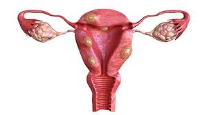 Gejala dan tanda menghidap kanser ovari. Fibroid Rahim Gejala Penyebab Faktor Risiko Diagnosis Pengobatan Pencegahan Kapan Harus Ke Dokter Halodoc Com