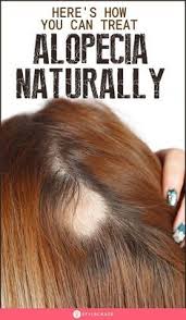 Biotin Oil For Hair Growth Results What Is Alopecia And How To Treat It Naturally Watching Clumps Of Hair Fall Out Of Your Scalp Can Never In 2020 Hair Fall Remedy Home Hair Fall Remedy Treat Alopecia