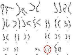 All these syndromes, because of their overlapping features, are now designated as a 22q11.2 deletion syndrome (22q11.2ds) mother and children with 22q11.2 deletion syndrome. Digeorge Syndrome 22q11 2 Deletion Syndrome The Oncofertility Consortium