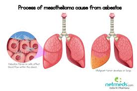 After the microscopic mineral fibers are inhaled, . Mesothelioma Causes Symptoms And Treatment