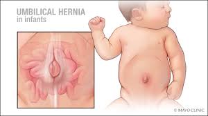 Mayo Clinic Q And A Umbilical Hernias In Infants Mayo