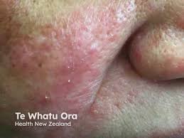 Image result for demodex rosacea