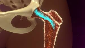 People talk about bone marrow cancer they are usually referring to multiple myeloma. Bone Marrow Transplantation As A Treatment Option What You Need To Know Cancer Therapy Advisor