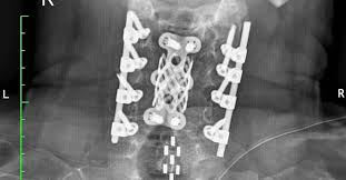 Image result for Spinal Trauma