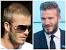Bollywood Celebrities Hair Transplant