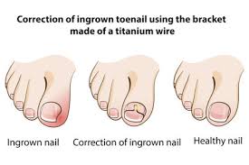 home remes for ingrown toenails