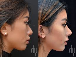 Before And After Revision Asian Rhinoplasty With Rib Cartilage And Dcf Diced Cartilage Fascia Rhinoplasty Facial Plastic Surgery Rhinoplasty Before And After