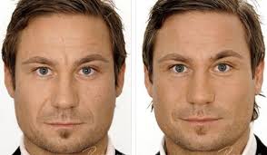 Here are 11 tips from realself community members that you may find helpful. Before And After Dermal Fillers Har Och Skonhet Skonhet