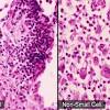 These subtypes, which start from different types of lung cells are grouped together as nsclc because their treatment and prognoses (outlook) are often similar. Https Encrypted Tbn0 Gstatic Com Images Q Tbn And9gcrba9nepkvoxdh3592g Rp7xb58kgccf1tryv8idu0jhft64kcz Usqp Cau