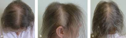 Definition alopecia diffusa ist ein mehr oder weniger gleichmäßig verteilter haarausfall aufgrund verschiedener ursachen. Figure 11 Alopecia Androgenetica Der Frau Springerlink