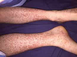 The inflammationcauses bloodvessels in the skin, intestines, kidneys,. Acute Abdominal Pain Henoch Schonlein Purpura Case In A Young Adult A Rare But Important Diagnosis Rcp Journals