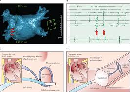 Image result for Atrial Fibrillation Rhythm Control