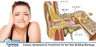 Do Excessive Ear Wax Causes Hearing Loss What Are The Natural Ways To Remove Earwax If You Have Simil Best Ear Wax Removal Ear Cleaning Wax Clean Ear Wax Out