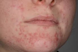 Den hudutslag i ansiktet beror på infektioner, allergier, värme och även läkemedel. Perioral Dermatit 1177 Vardguiden