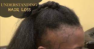 12 Reasons Why You May Be Experiencing Mild To Severe Hair Loss Why Hair Loss Severe Hair Loss Black Hair Tips