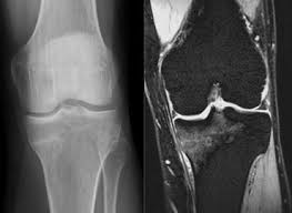 Image result for Tibia Stress Fracture