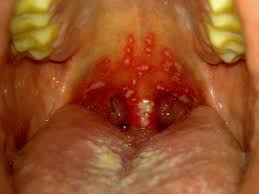 Image result for Canker sores symptoms roof of the mouth