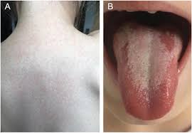 Image result for Scarlet Fever