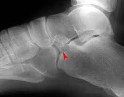 Image result for Calcaneus Compression Fracture