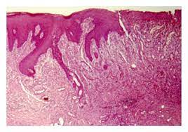 We present a case of necrotizing. Necrotizing Sialometaplasia Of Palate A Case Report
