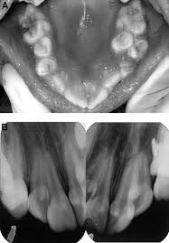 Patients with bscl present with a distinct phenotype since s. Talon Cusps Macrodontia And Aberrant Tooth Morphology In Berardinelli Seip Syndrome Oral Surgery Oral Medicine Oral Pathology Oral Radiology And Endodontics