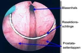 Turp Transurethrale Resektion Der Prostata Ablauf Und Risiken