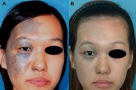 Comparing The Effectiveness Of Q Switched Ruby Laser Treatment With That Of Q Switched Nd Yag Laser For Oculodermal Melanosis Nevus Of Ota Sciencedirect