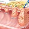 Advanced bowel cancer is cancer that started in either the back passage (rectum) or large bowel (colon) and has spread to another part of the body. 1