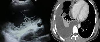 Pleural effusion can be a sign of serious illness. Epos Trade