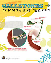 Image result for Biliary Colic