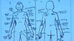 What was done to gabriel fernandez? Slain Palmdale Boy Had Bb Lodged In Groin Skin Missing From His Neck Nurse Testifies Abc7 Los Angeles