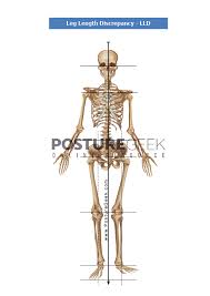 Image result for Functional Leg Length Discrepancy
