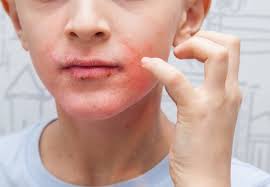 Image result for Impetigo