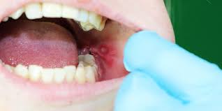 Image result for Canker sores roof of mouth