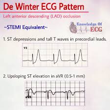 A service of the national library of medicine, national institutes of health. Knowledge Of Ecg Fotos Facebook