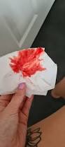 Image result for First Trimester Bleeding