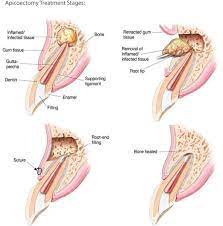 Pin By Vanessa Bacsarszki On Surgery Dental Braces Dentistry Root Canal Treatment