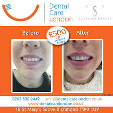 For example, apply a paste on the teeth and. Dental Care London Home Facebook