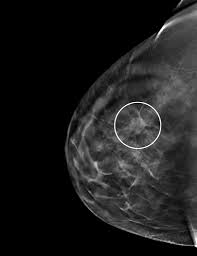 Whether you're getting a screening mammogram or a diagnostic mammogram, the basic procedure is the same. 3 D Mammography Test Appears To Improve Breast Cancer Detection Rate The New York Times