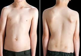 Why does my back bone stick out bone rubbing bone in back download here free healthcaremagic app to ask a doctor. Scoliosis Nhs