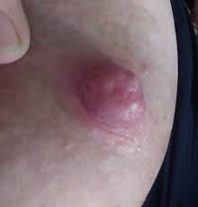 How often should you soak a milk blister? When Breastfeeding Hurts Nipple Blebs Mattos Lactation