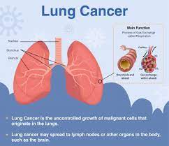Lung cancer is a lot of pain in the community. Overview Of Lung Cancer Signs Symptoms Diagnosis Treatment