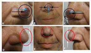 According to the american cancer society, just over 100,000 new cases of skin cancer are diagnosed in the united states each year. Cureus Pigmented Basal Cell Carcinoma Masquerading As A Melanoma