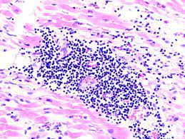 Se estableció el diagnóstico de miocarditis por dengue grave y se inició tratamiento con corticoides utilizando metilprednisolona (500 mg en bolo i.v. Rol Actual De La Biopsia Endomiocardica En El Estudio De Las Miocarditis Y Miocardiopatias Inflamatorias Sac Sociedad Argentina De Cardiologia