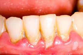 The bacteria in plaque can also cause the early stage of gum disease called gingivitis. Gingivitis Periodontitis Symptoms Treatment Of Gum Disease Live Science