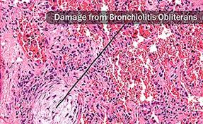 Just press the mouse bubbles. Popcorn Lung Causes Symptoms Diagnosis And Treatment