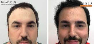 Descrizione, costi, foto prima e dopo. Trapianto Capelli Torino Tecnica E Costi Dell Alta Densita Hsd